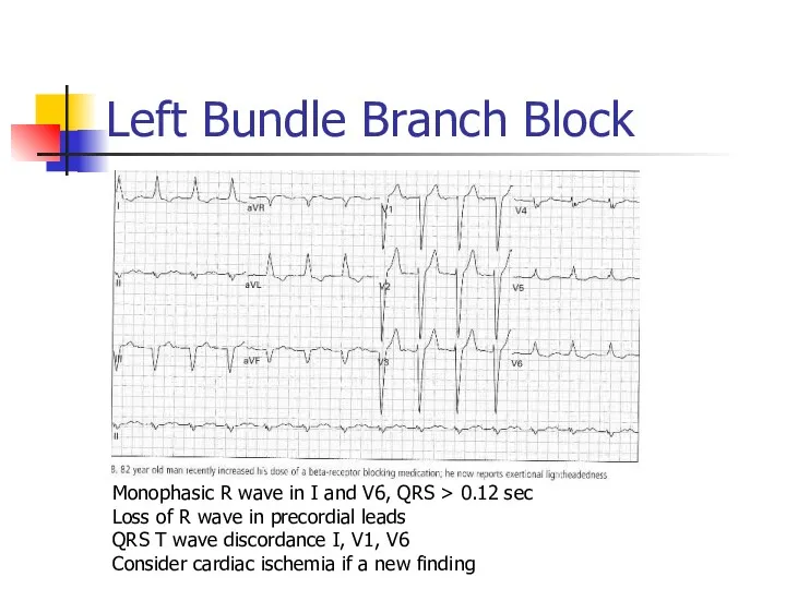 Left Bundle Branch Block Monophasic R wave in I and V6, QRS >