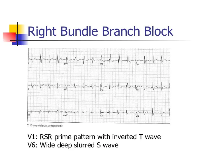 Right Bundle Branch Block V1: RSR prime pattern with inverted T wave V6: