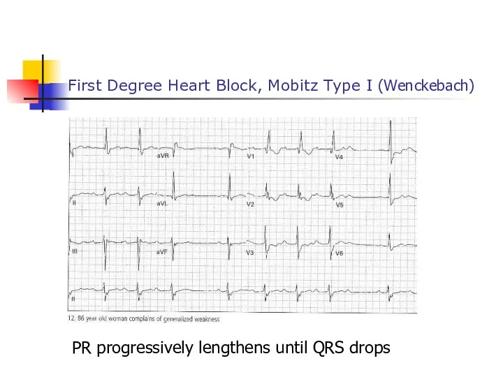 First Degree Heart Block, Mobitz Type I (Wenckebach) PR progressively lengthens until QRS drops
