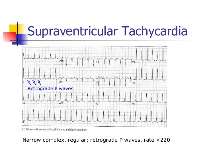 Supraventricular Tachycardia Narrow complex, regular; retrograde P waves, rate Retrograde P waves