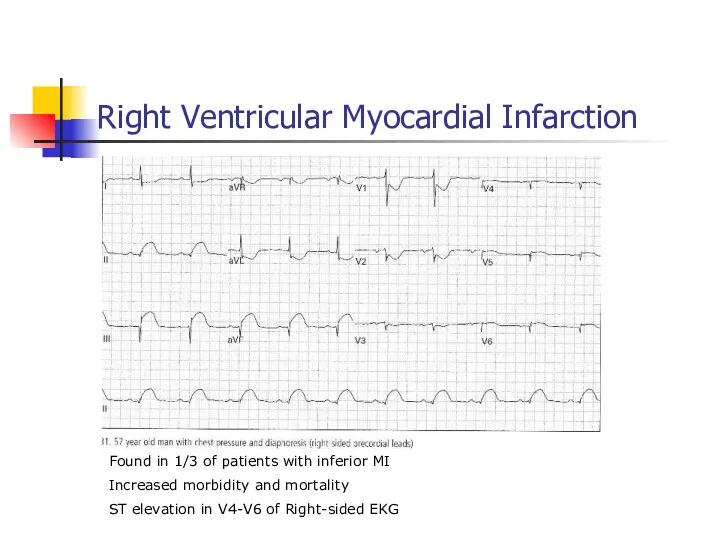 Right Ventricular Myocardial Infarction Found in 1/3 of patients with inferior MI Increased