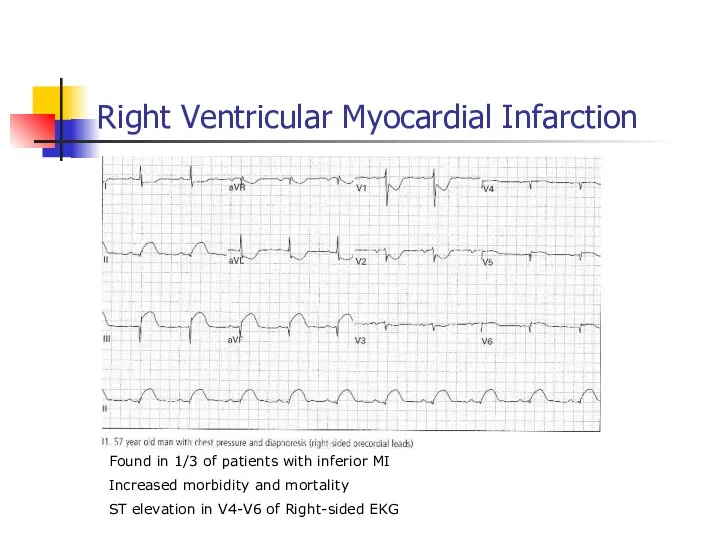 Right Ventricular Myocardial Infarction Found in 1/3 of patients with