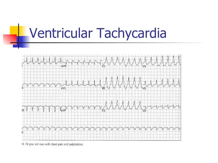 Ventricular Tachycardia