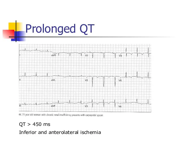 Prolonged QT QT > 450 ms Inferior and anterolateral ischemia