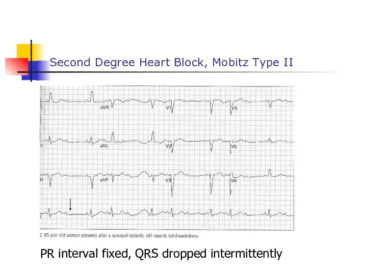 Second Degree Heart Block, Mobitz Type II PR interval fixed, QRS dropped intermittently