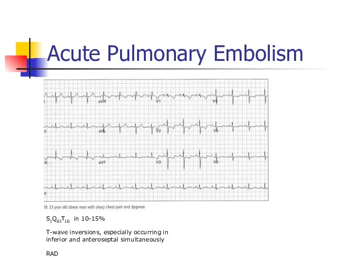 Acute Pulmonary Embolism SIQIIITIII in 10-15% T-wave inversions, especially occurring in inferior and anteroseptal simultaneously RAD