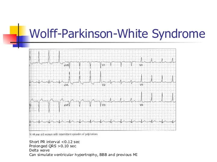 Wolff-Parkinson-White Syndrome Short PR interval Prolonged QRS >0.10 sec Delta wave Can simulate