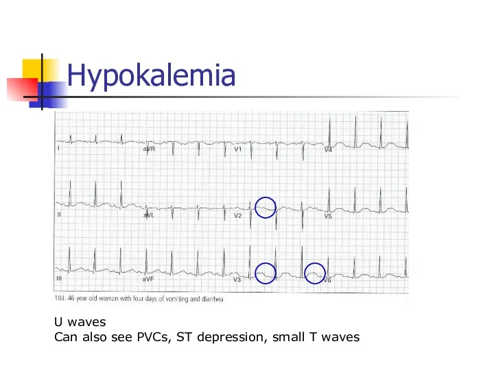 Hypokalemia U waves Can also see PVCs, ST depression, small T waves