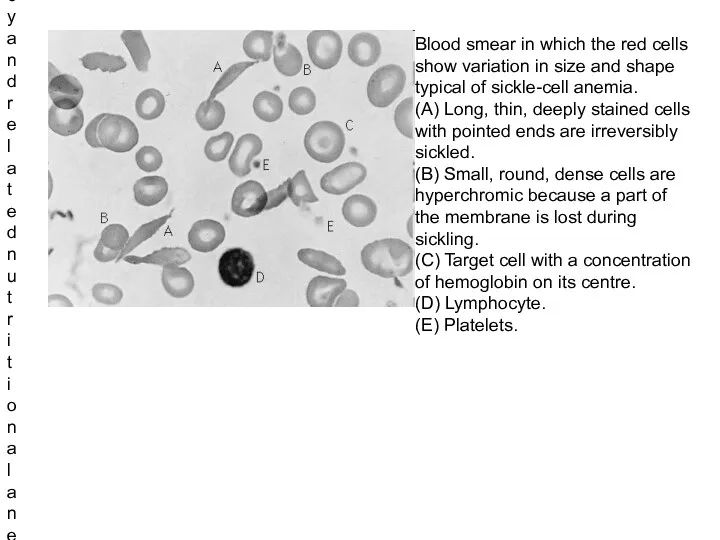 Blood smear in which the red cells show variation in