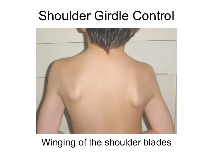 Shoulder Girdle Control Winging of the shoulder blades