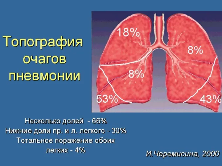 В России пневмонией ежегодно заболевает более 2 млн. человек. Правильный