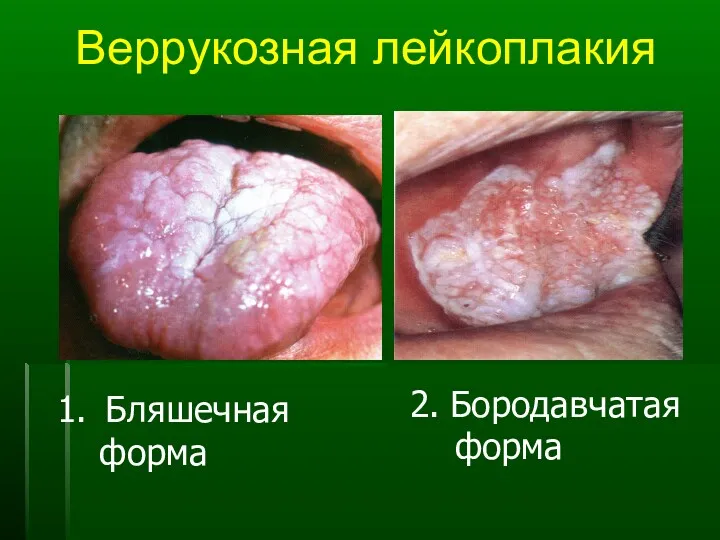 Веррукозная лейкоплакия Бляшечная форма 2. Бородавчатая форма