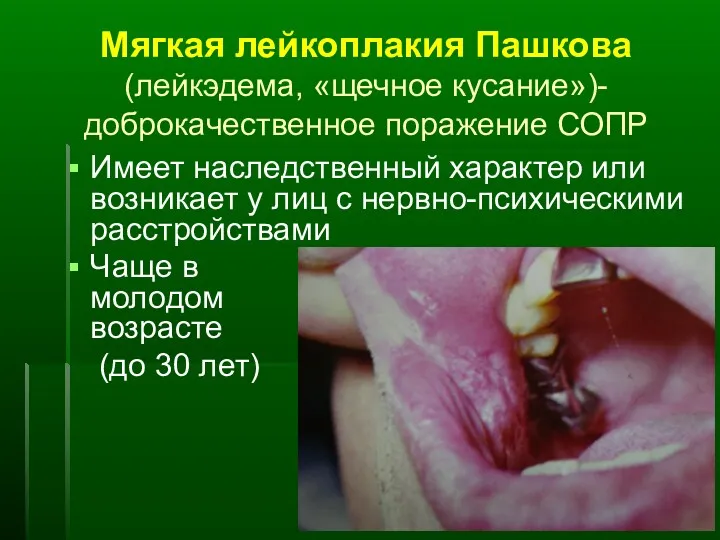 Мягкая лейкоплакия Пашкова (лейкэдема, «щечное кусание»)- доброкачественное поражение СОПР Имеет наследственный характер или