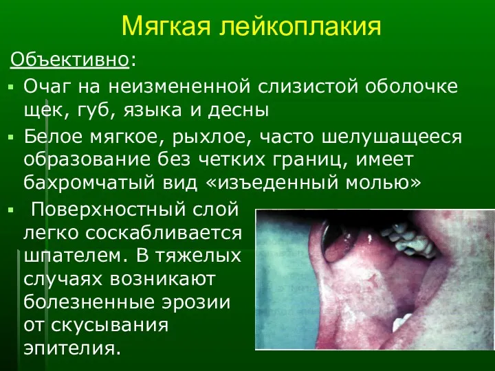 Мягкая лейкоплакия Объективно: Очаг на неизмененной слизистой оболочке щек, губ, языка и десны
