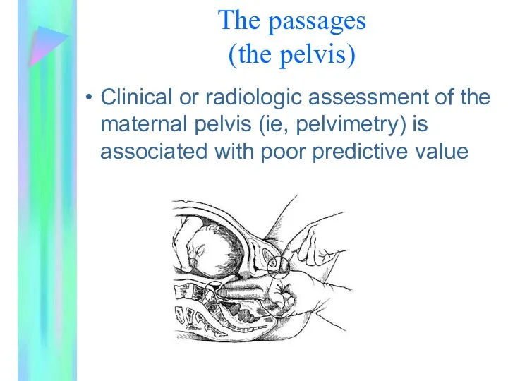 Clinical or radiologic assessment of the maternal pelvis (ie, pelvimetry)