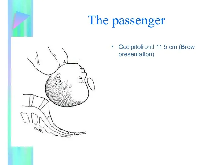 The passenger Occipitofrontl 11.5 cm (Brow presentation)