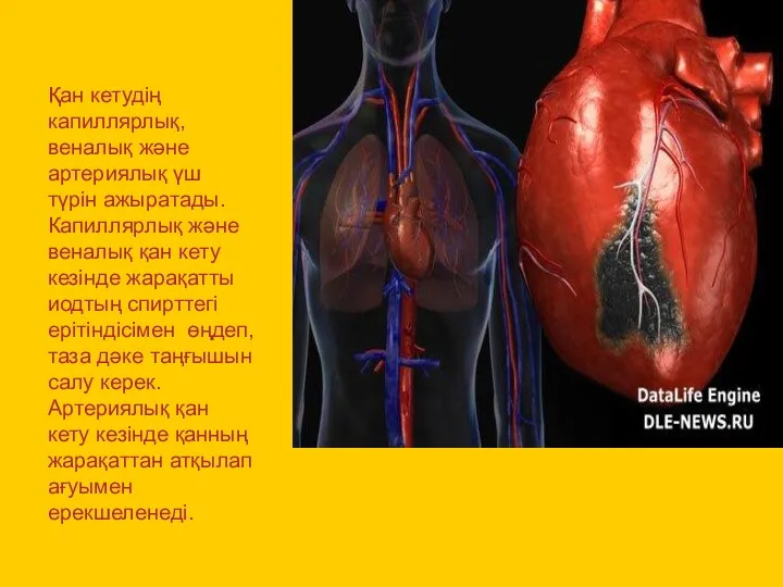 Қан кетудің капиллярлық, веналық және артериялық үш түрін ажыратады. Капиллярлық