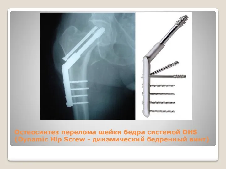 Остеосинтез перелома шейки бедра системой DHS (Dynamic Hip Screw - динамический бедренный винт)