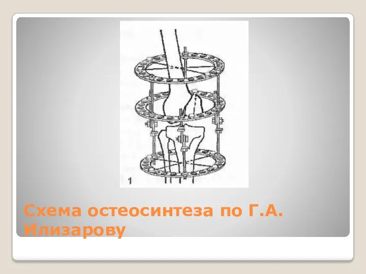 Схема остеосинтеза по Г.А. Илизарову