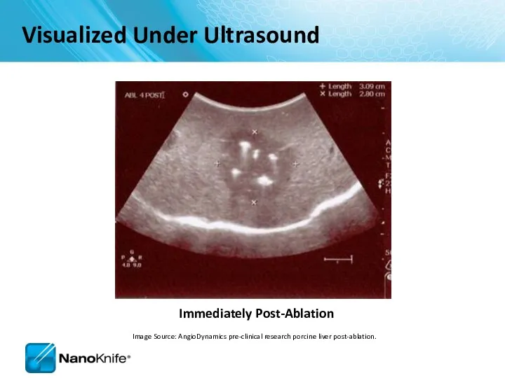 Immediately Post-Ablation Visualized Under Ultrasound Image Source: AngioDynamics pre-clinical research porcine liver post-ablation.