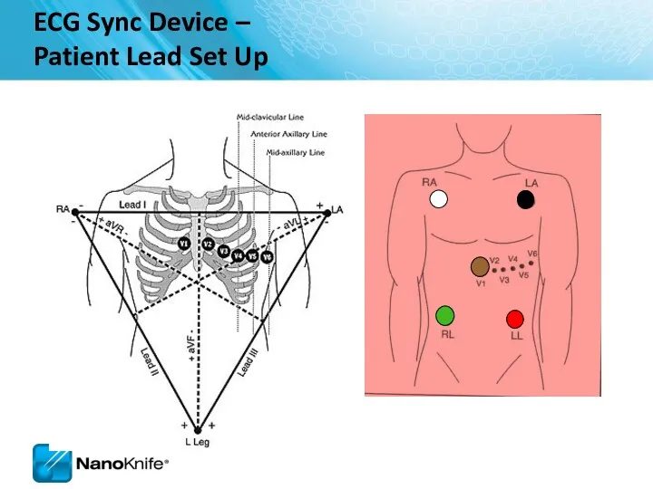 ECG Sync Device – Patient Lead Set Up