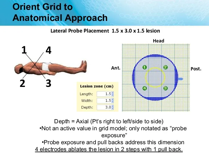 Orient Grid to Anatomical Approach Head Lateral Probe Placement 1.5