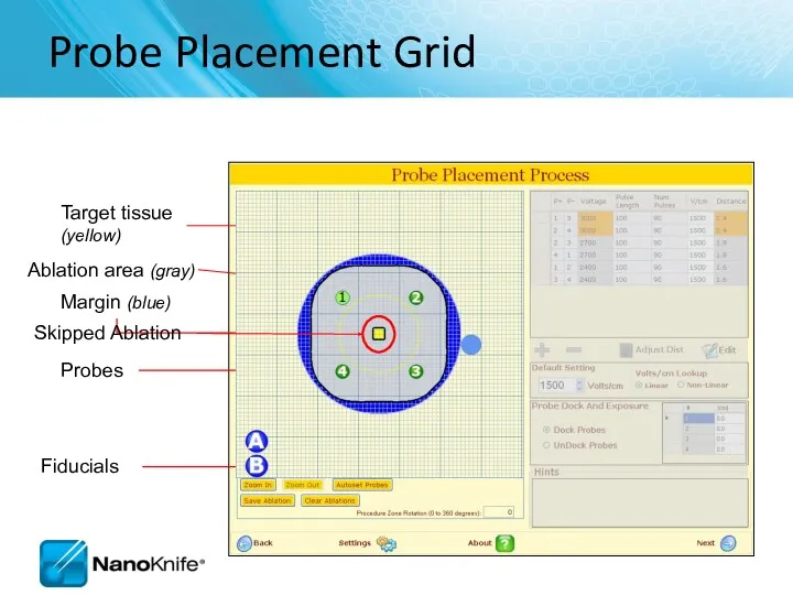 Probe Placement Grid Probes Target tissue (yellow) Ablation area (gray) Fiducials Skipped Ablation