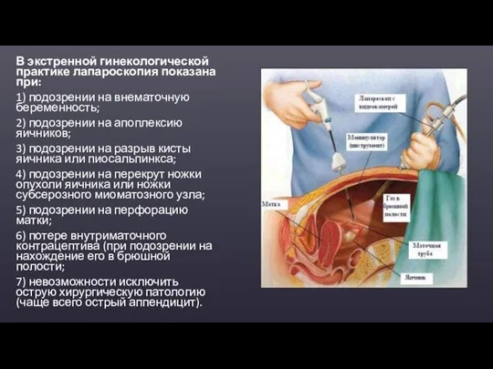 В экстренной гинекологической практике лапароскопия показана при: 1) подозрении на