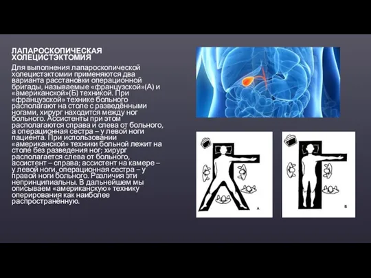 ЛАПАРОСКОПИЧЕСКАЯ ХОЛЕЦИСТЭКТОМИЯ Для выполнения лапароскопической холецистэктомии применяются два варианта расстановки