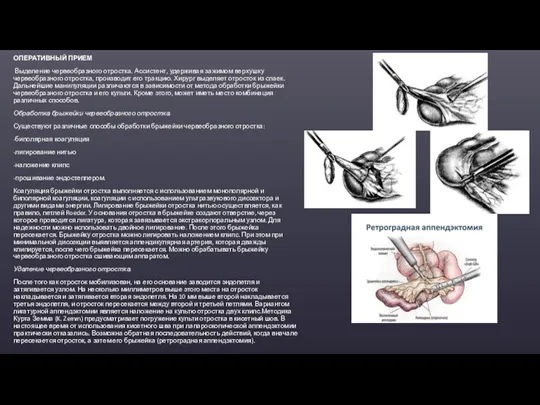 ОПЕРАТИВНЫЙ ПРИЕМ Выделение червеобразного отростка. Ассистент, удерживая зажимом верхушку червеобразного