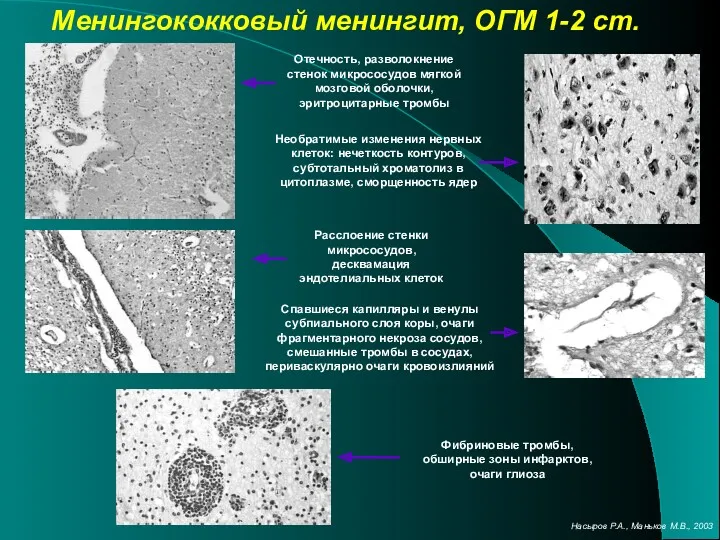 Отечность, разволокнение стенок микрососудов мягкой мозговой оболочки, эритроцитарные тромбы Менингококковый менингит, ОГМ 1-2