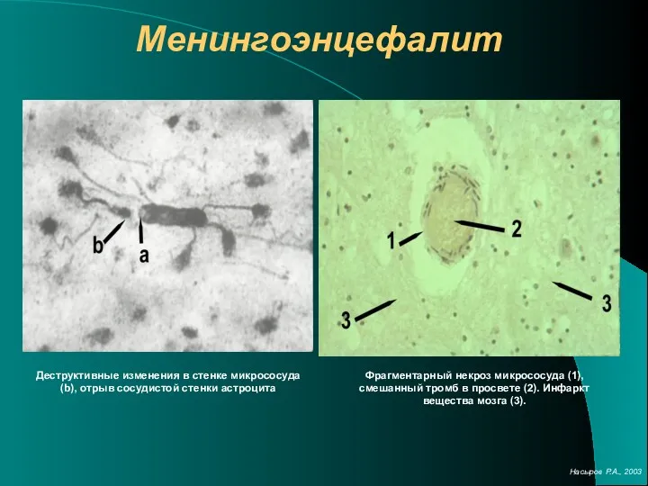 Менингоэнцефалит Деструктивные изменения в стенке микрососуда (b), отрыв сосудистой стенки астроцита Фрагментарный некроз