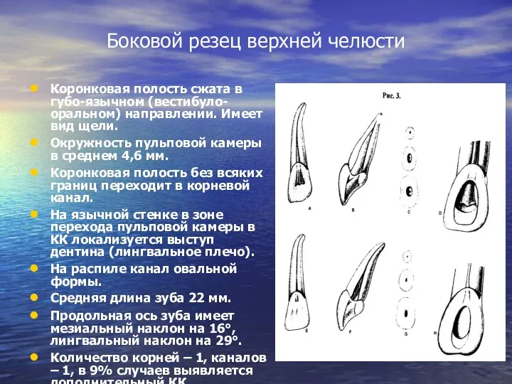 Боковой резец верхней челюсти Коронковая полость сжата в губо-язычном (вестибуло-оральном) направлении. Имеет вид