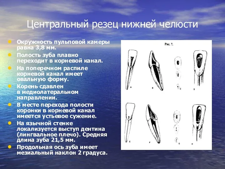 Окружность пульповой камеры равна 3,8 мм. Полость зуба плавно переходит в корневой канал.