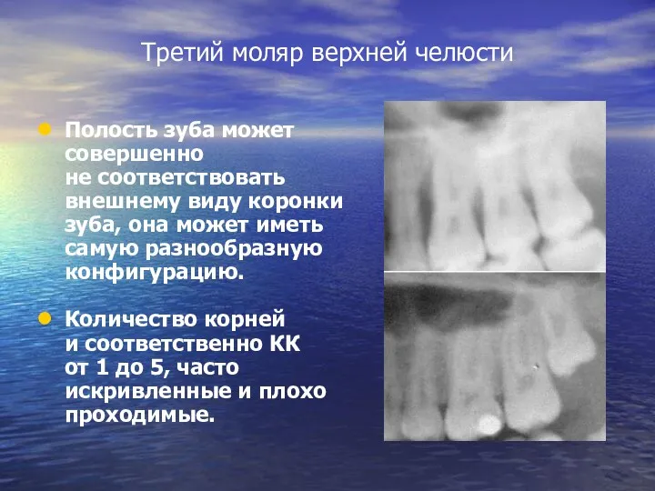 Третий моляр верхней челюсти Полость зуба может совершенно не соответствовать внешнему виду коронки