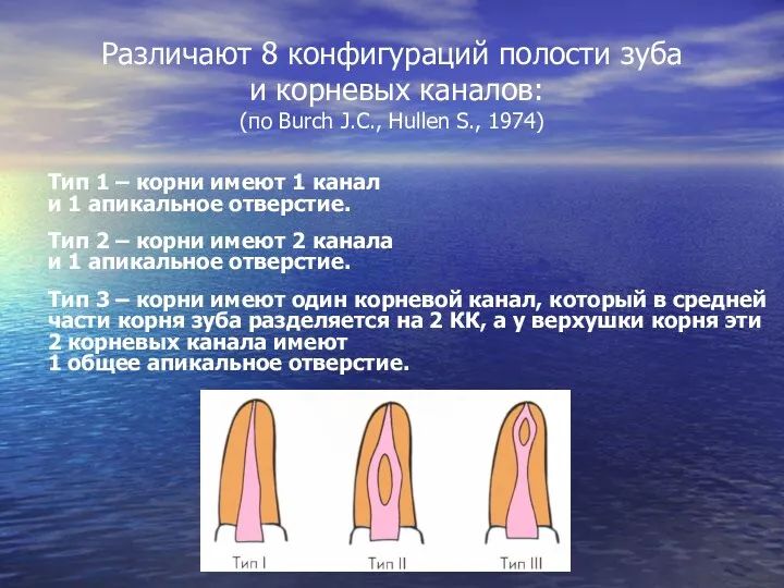 Различают 8 конфигураций полости зуба и корневых каналов: (по Burch J.C., Hullen S.,