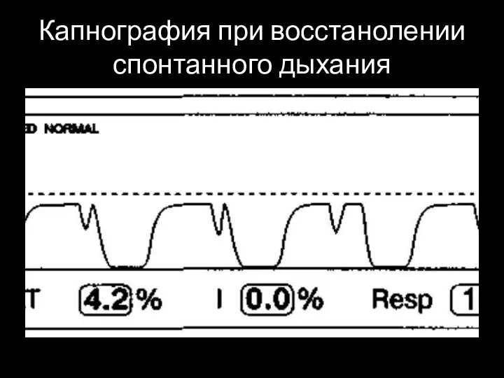 Капнография при восстанолении спонтанного дыхания