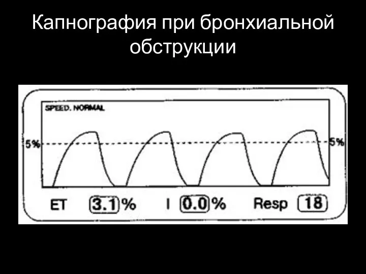 Капнография при бронхиальной обструкции