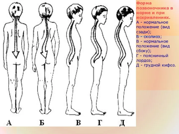 Форма позвоночника в норме и при искривлениях. А - нормальное