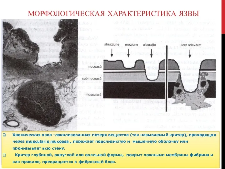 Хроническая язва -локализованная потеря вещества (так называемый кратер), проходящяя через