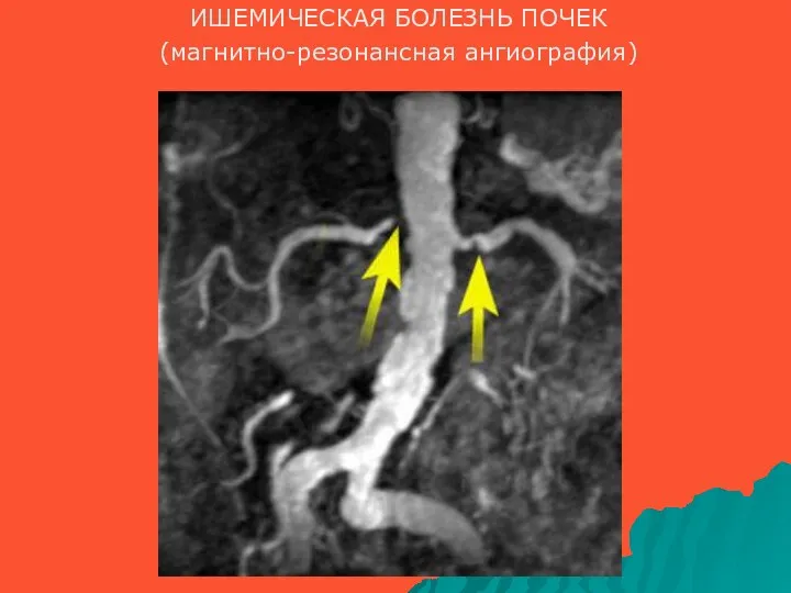 ИШЕМИЧЕСКАЯ БОЛЕЗНЬ ПОЧЕК (магнитно-резонансная ангиография)