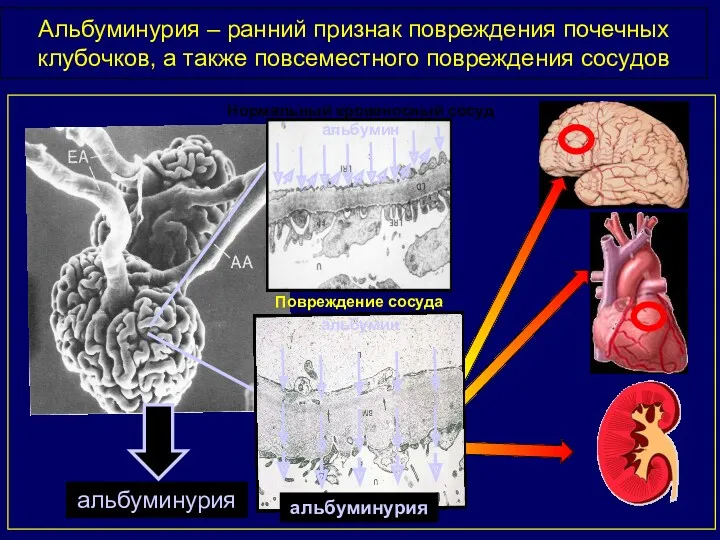 Альбуминурия – ранний признак повреждения почечных клубочков, а также повсеместного повреждения сосудов альбумин