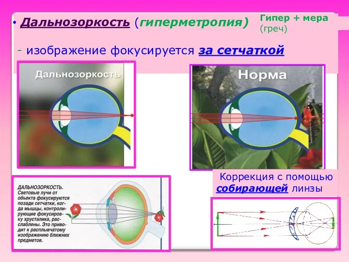 Дальнозоркость (гиперметропия) - изображение фокусируется за сетчаткой Коррекция с помощью собирающей линзы Гипер + мера (греч)