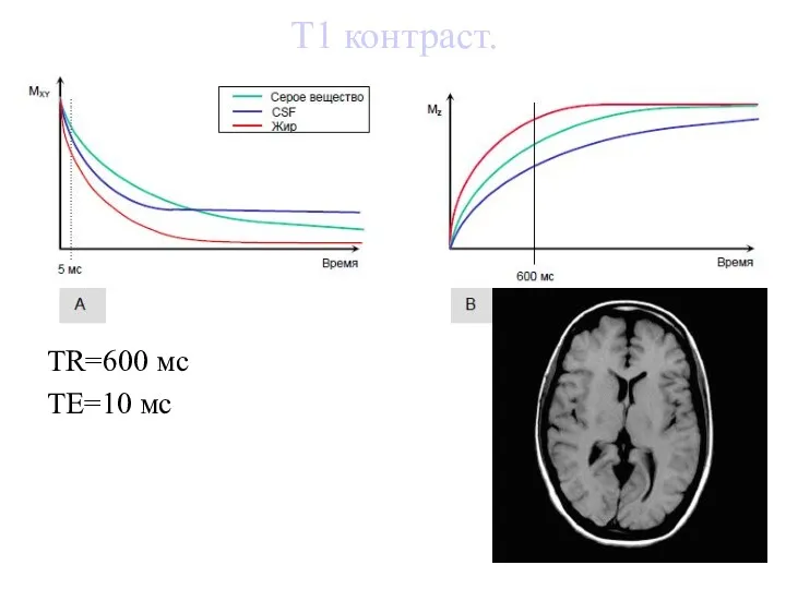 Т1 контраст. TR=600 мс TE=10 мс