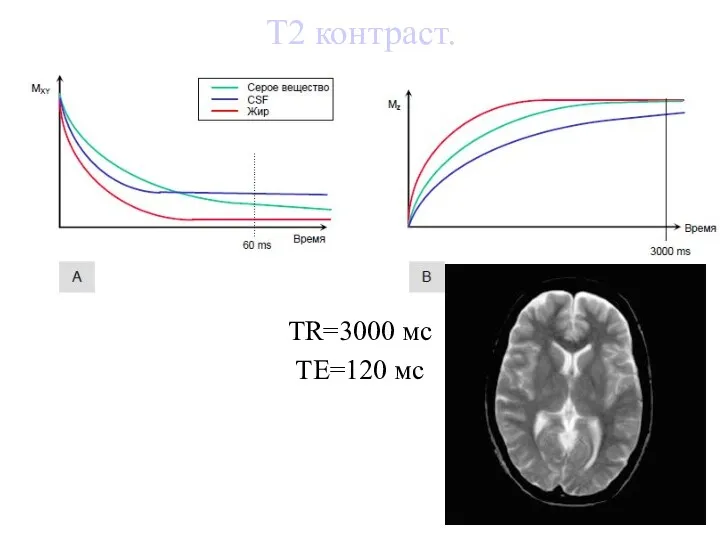 Т2 контраст. TR=3000 мс TE=120 мс