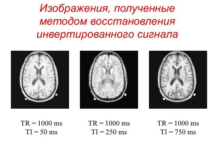 Изображения, полученные методом восстановления инвертированного сигнала TR = 1000 ms