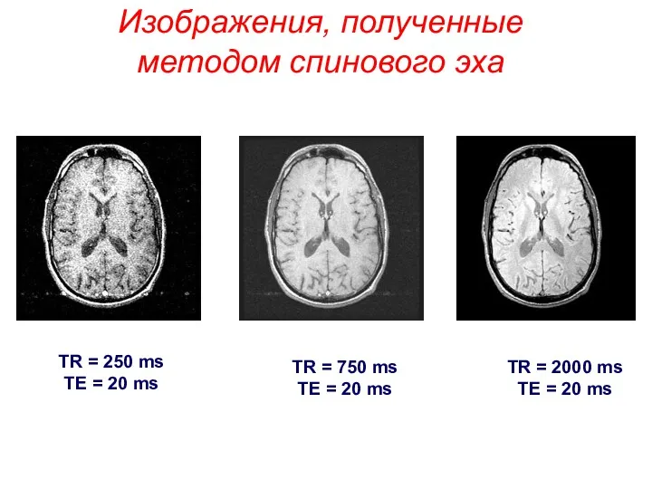 Изображения, полученные методом спинового эха TR = 250 ms TE