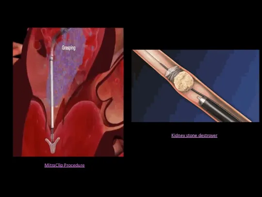 MitraClip Procedure Kidney stone destroyer