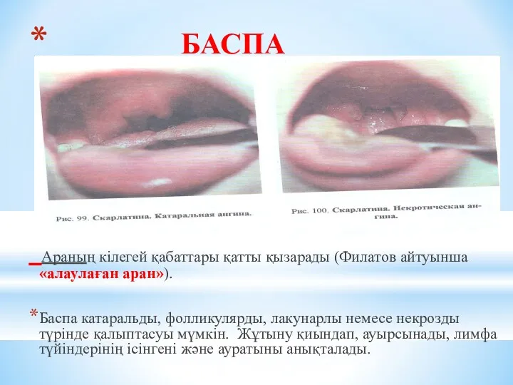 БАСПА Араның кілегей қабаттары қатты қызарады (Филатов айтуынша «алаулаған аран»).