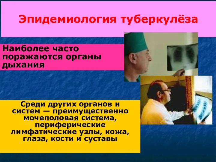 Эпидемиология туберкулёза Наиболее часто поражаются органы дыхания Среди других органов